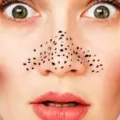 Trik Memencet Komedo Sendiri di Rumah dengan Benar Berdasarkan Saran Dermatologist