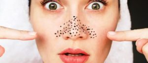 Trik Memencet Komedo Sendiri di Rumah dengan Benar Berdasarkan Saran Dermatologist