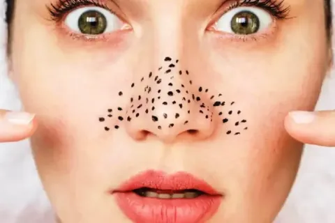 Trik Memencet Komedo Sendiri di Rumah dengan Benar Berdasarkan Saran Dermatologist
