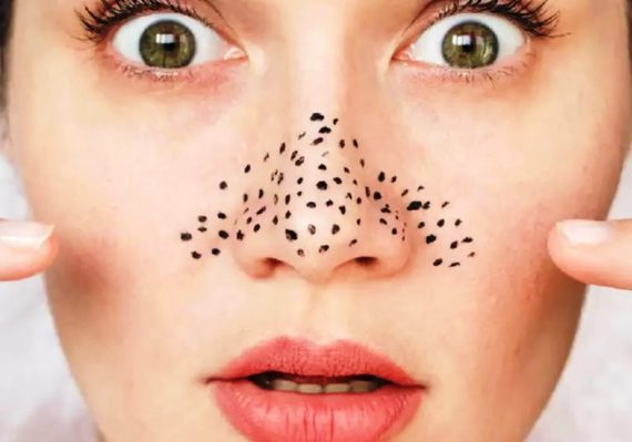 Trik Memencet Komedo Sendiri di Rumah dengan Benar Berdasarkan Saran Dermatologist