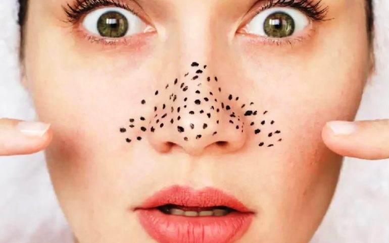 Trik Memencet Komedo Sendiri di Rumah dengan Benar Berdasarkan Saran Dermatologist