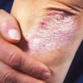 Mengenal Jenis Psoriasis yang Perlu Diketahui