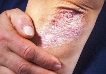 Mengenal Jenis Psoriasis yang Perlu Diketahui