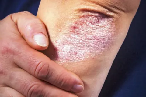 Mengenal Jenis Psoriasis yang Perlu Diketahui