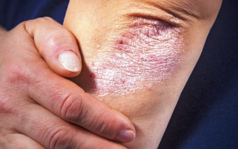 Mengenal Jenis Psoriasis yang Perlu Diketahui